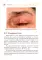 Халазион